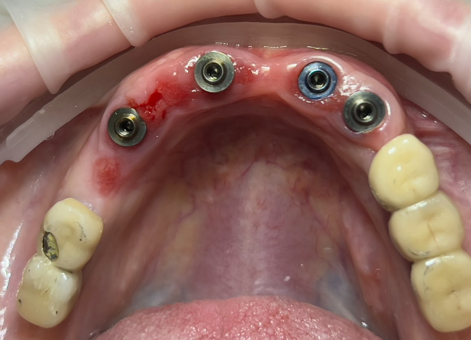 surgical-stage-immediate-implant-placement