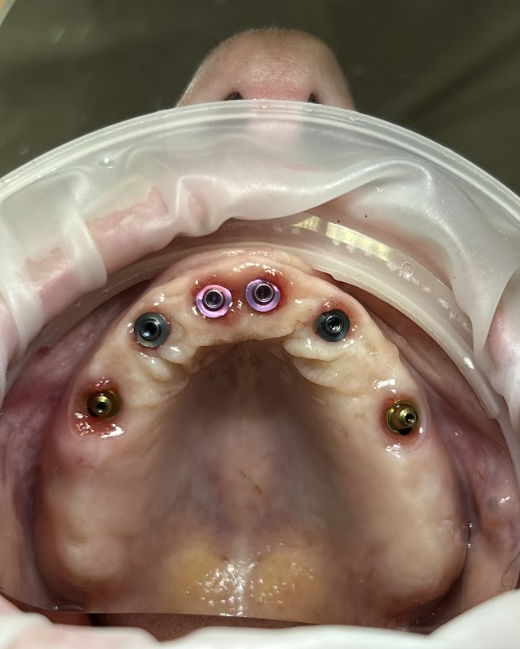 Clinical photograph of the maxillary arch showing the replacement of gold-colored 1 mm multi-unit abutments with pink-colored 3 mm ones, highlighting XGate Dental's color-coding system