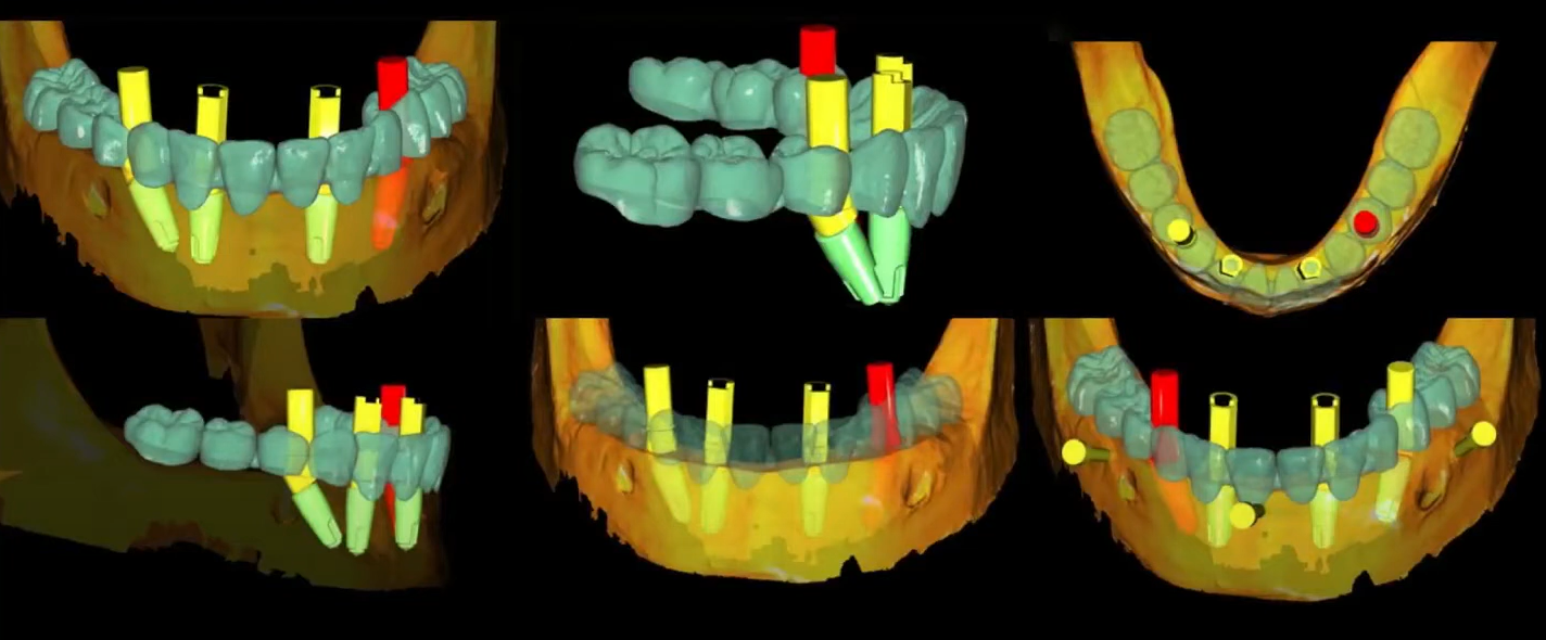 Aligning the planned restoration with the dental implant placement sites