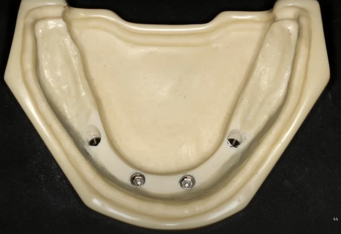 All four implants have been placed with bone recontouring