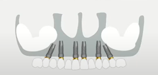 Fixed prosthesis diagram for the full-arch on 6 implant protocol