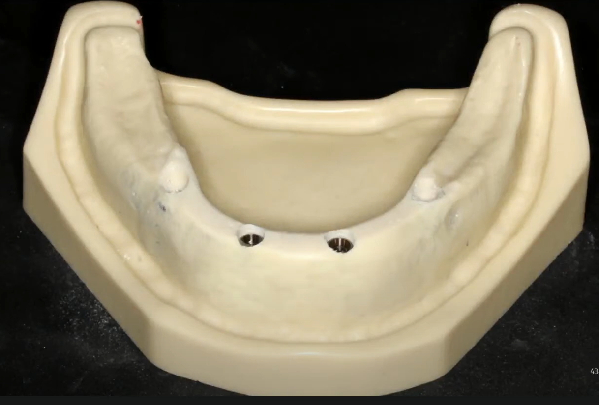 The first two implants have been placed in the training model
