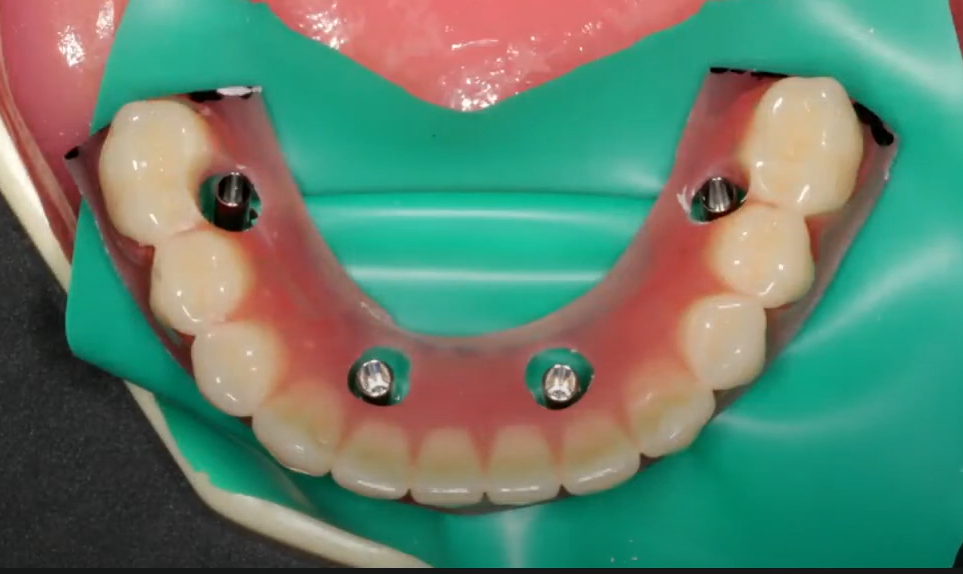 Preliminary attachment of a temporary prosthesis to cylinders