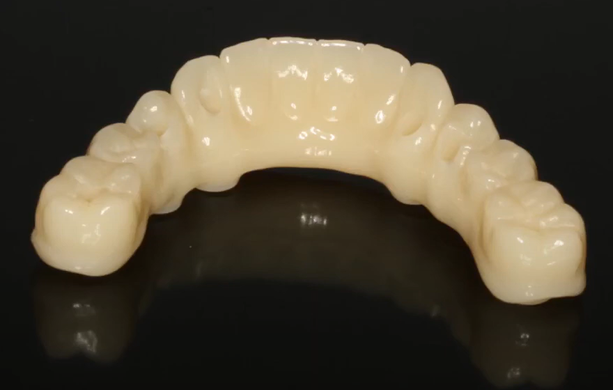 A highly aesthetic and durable long-term temporary prosthesis milled from a block of PMMA using CAD/CAM technology.