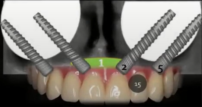 Complete atrophy requiring a subperiosteal zygomatic framework