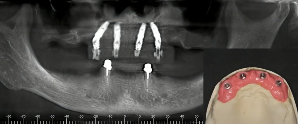 The final, polished, screw-retained provisional prosthesis successfully installed in the patient's upper jaw.