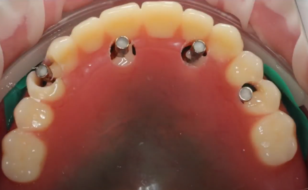 A small amount of light-curing composite is used for the initial fixation of the temporary denture to the multi-unit abutment sleeves.