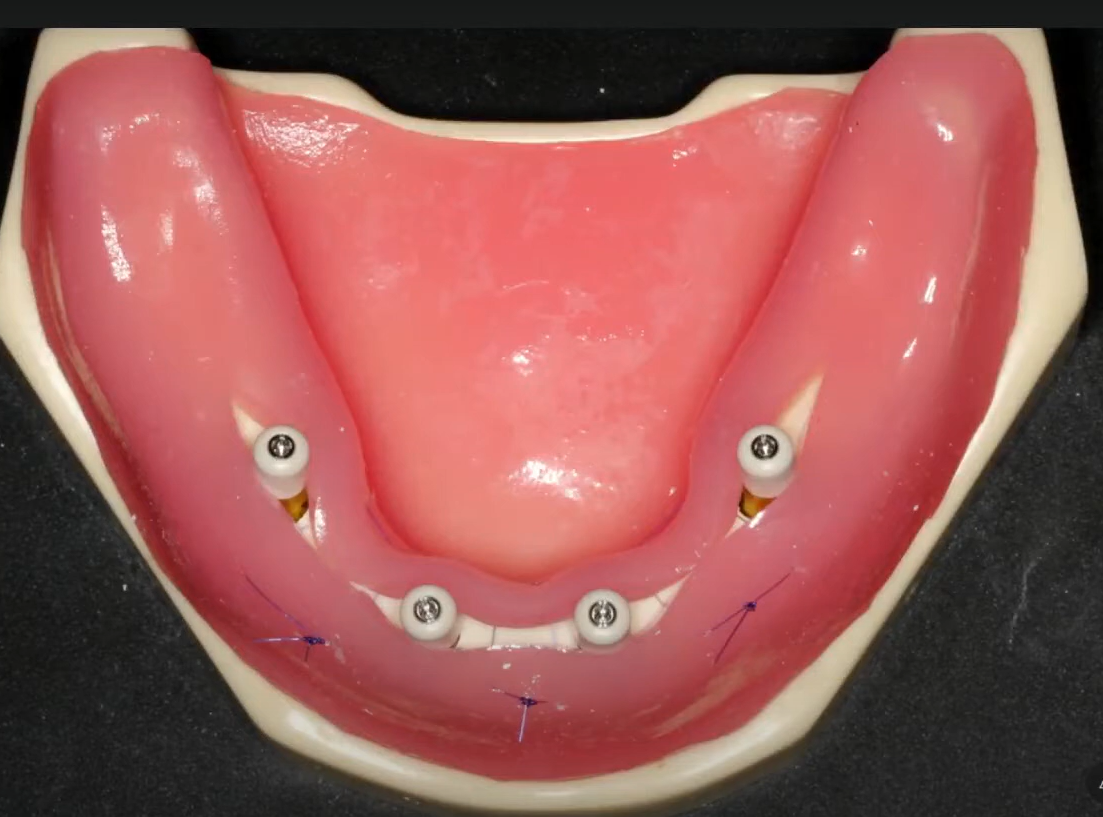 Preliminary flap stabilization with large sutures