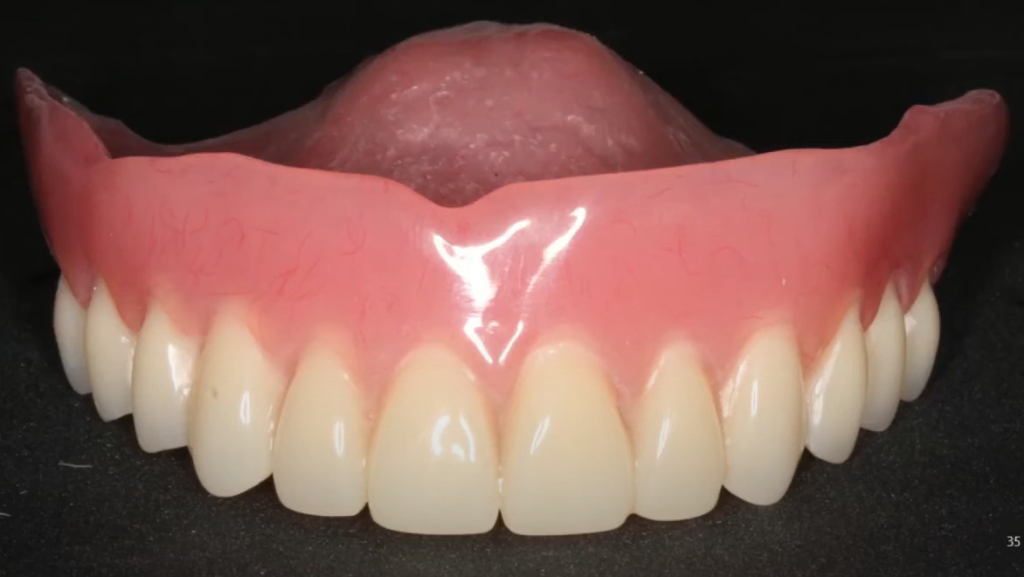 The palatal view of the temporary denture, which uses the palate as a stable landmark for correct positioning.