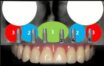 Sufficient bone for classic restoration