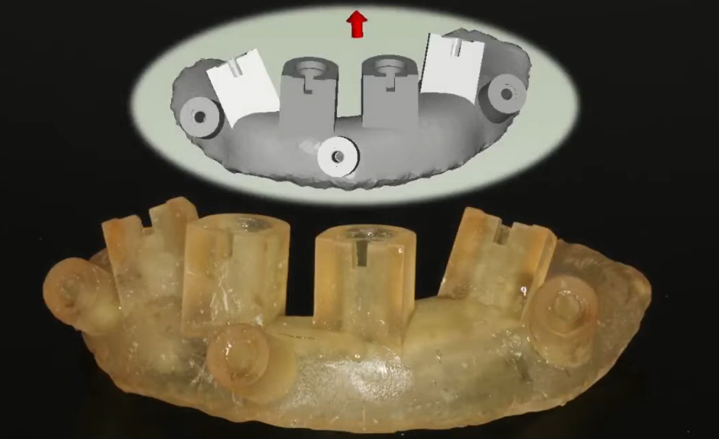A fully guided surgical template controls not only the depth and angle of implant insertion but also the rotational position of the internal interface.