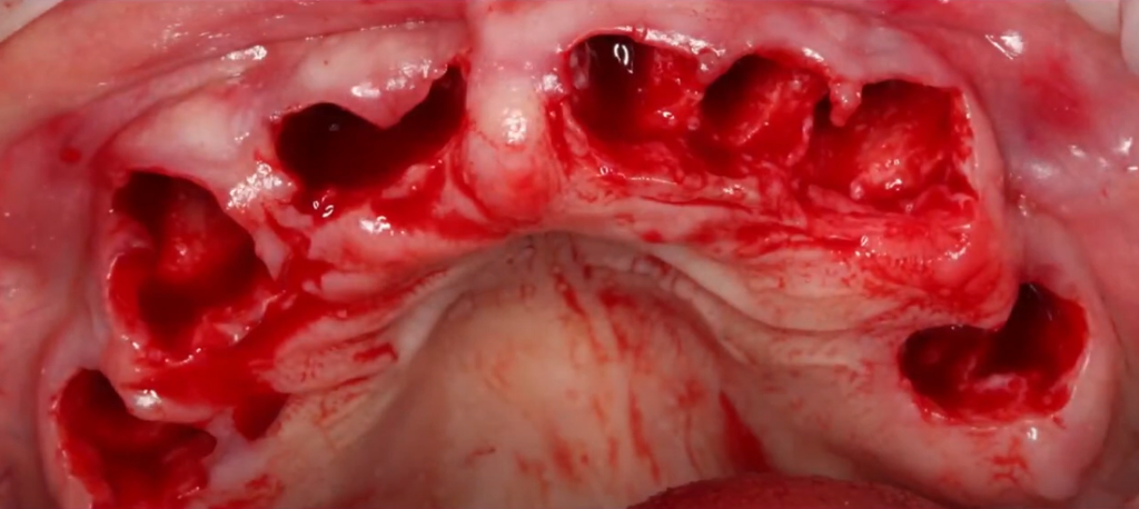 The condition of the patient's upper jaw gums immediately after the atraumatic extraction of all teeth.