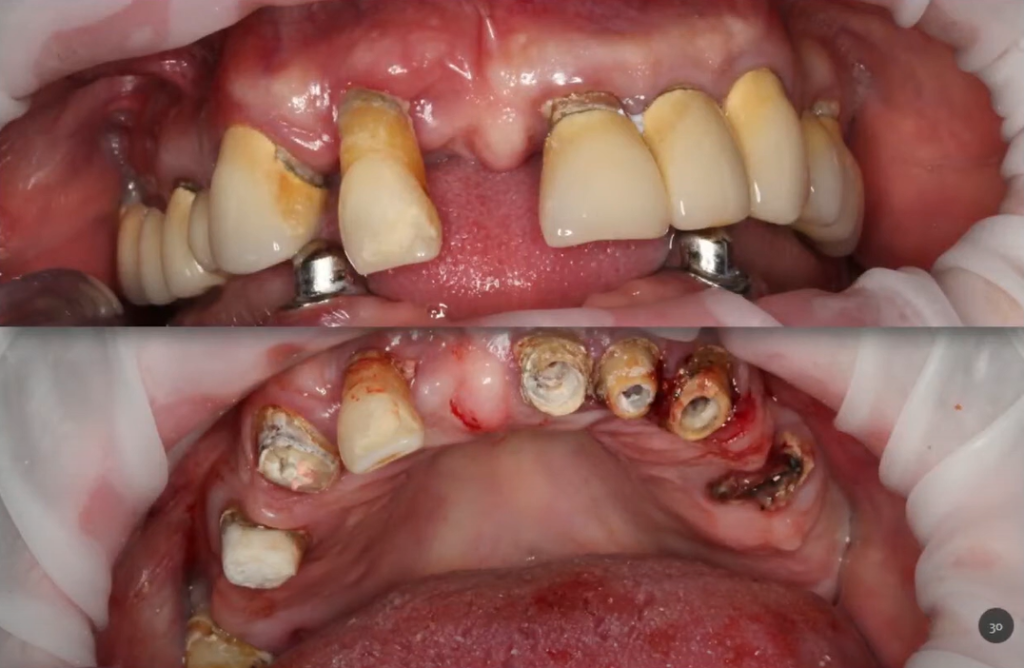 Occlusal view of the patient's upper arch, displaying the remaining hopeless teeth before extraction.
