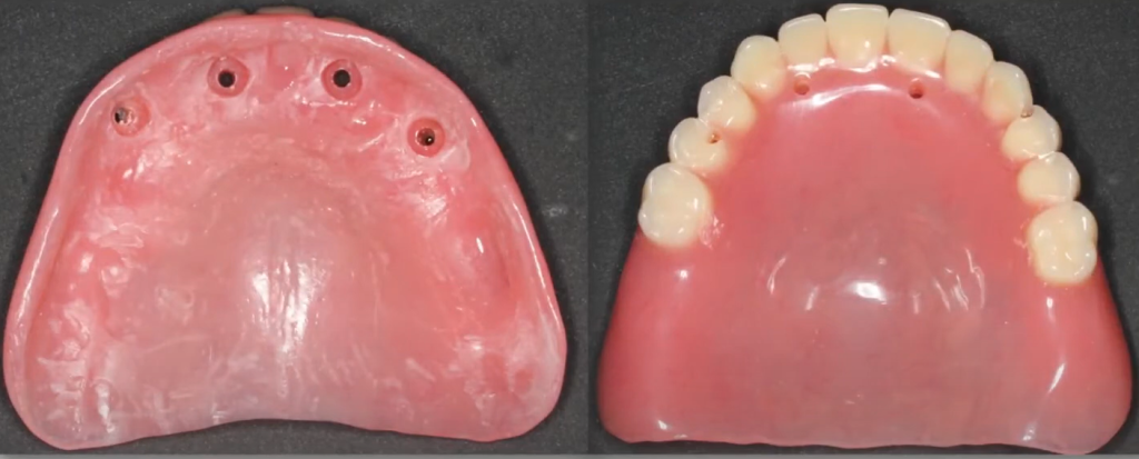 Frontal view of the tissue-supported temporary denture before its conversion to a screw-retained provisional prosthesis.