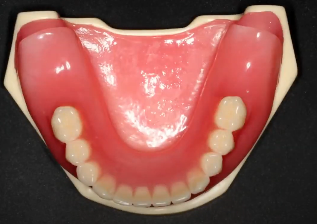Model of a jaw with a tissue-supported removable denture