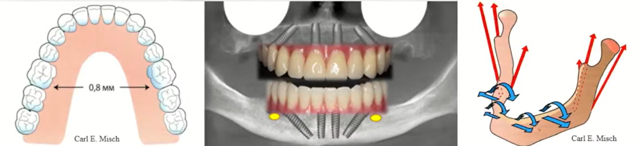 The principle of mandibular deformation and its implications for prosthetics supported by anteriorly placed implants