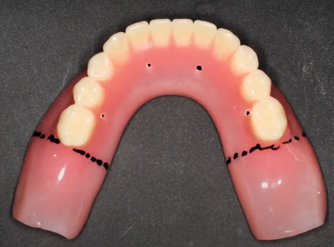Marking and removing the excess flange from the removable denture