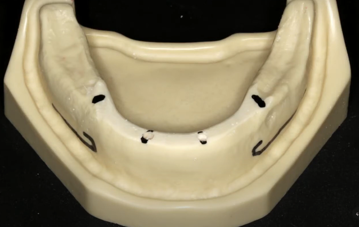 Marking the implant placement sites for a full-arch protocol on 4 or 6 implants
