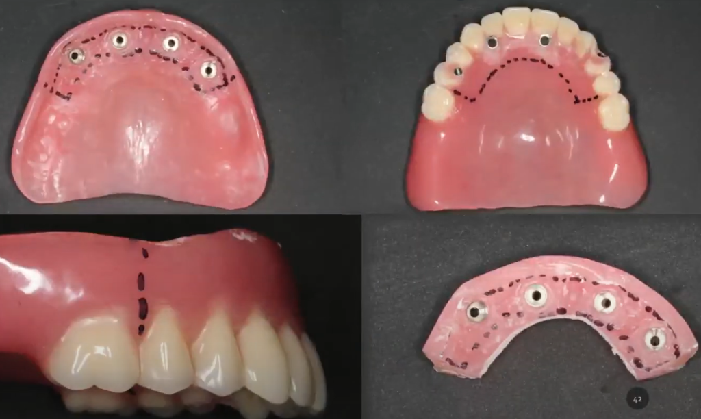 The trimmed temporary denture is placed back in the patient's mouth to check for proper fit and occlusion.