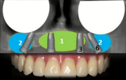 Mild atrophy suitable for a full-arch restoration on 6 implants