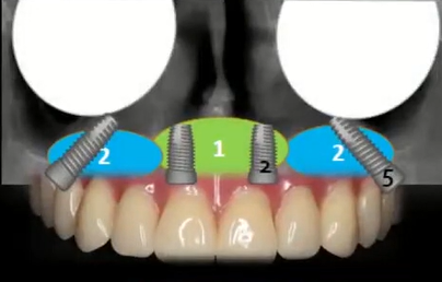 Moderate atrophy suitable for a full-arch restoration on 4 implants