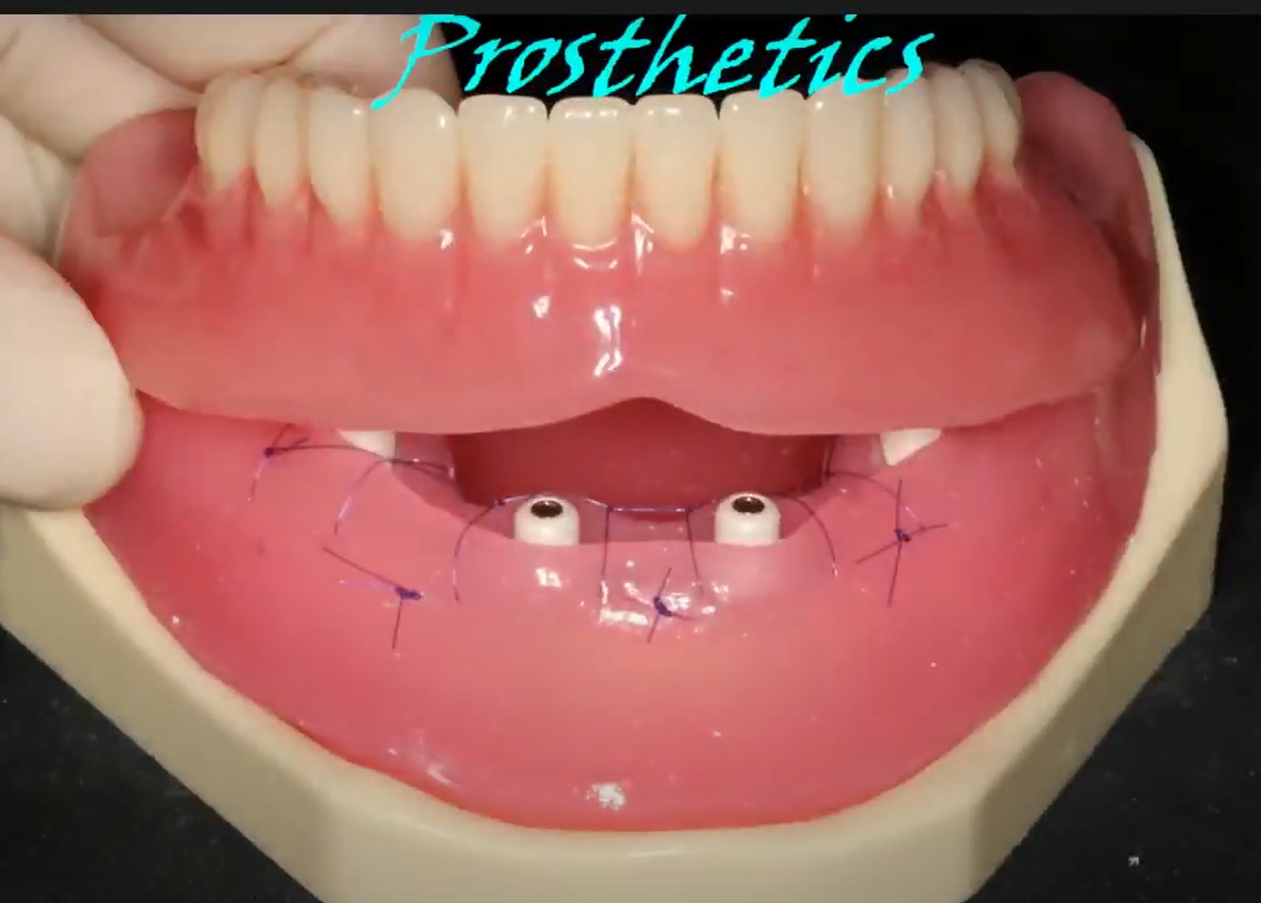 Beginning the modification of a removable denture
