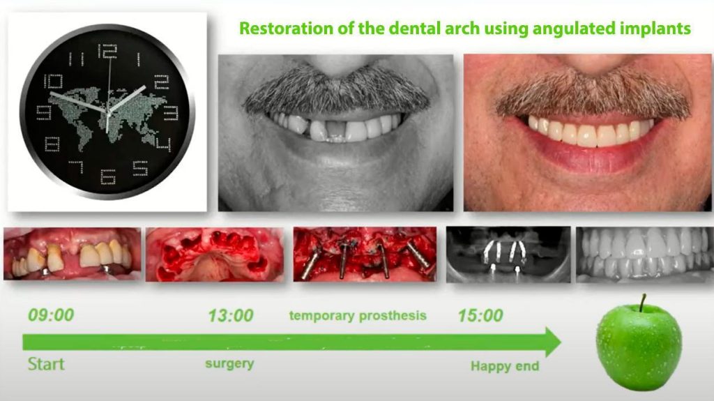Before and after photos of a patient's smile, showing missing teeth replaced with a full upper arch prosthesis.