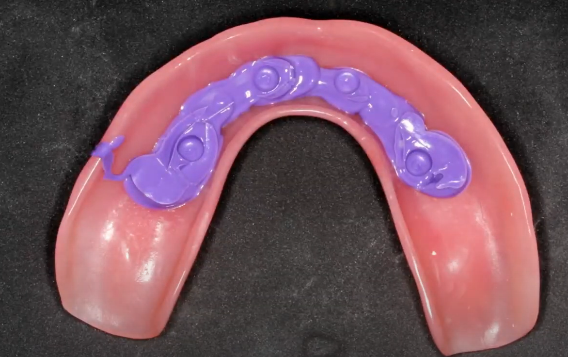 Impression marking the implant locations on the old removable prosthesis