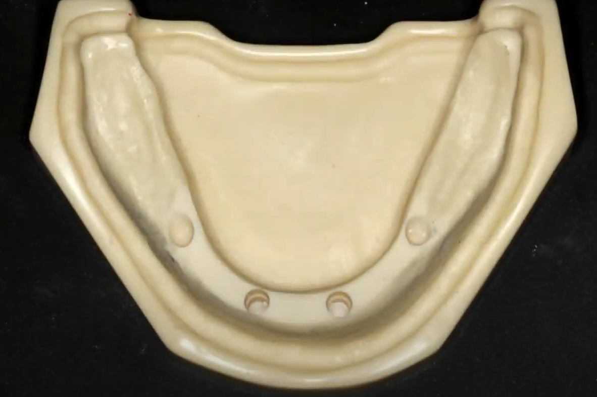 Pilot drilling to prepare the osteotomy for implants
