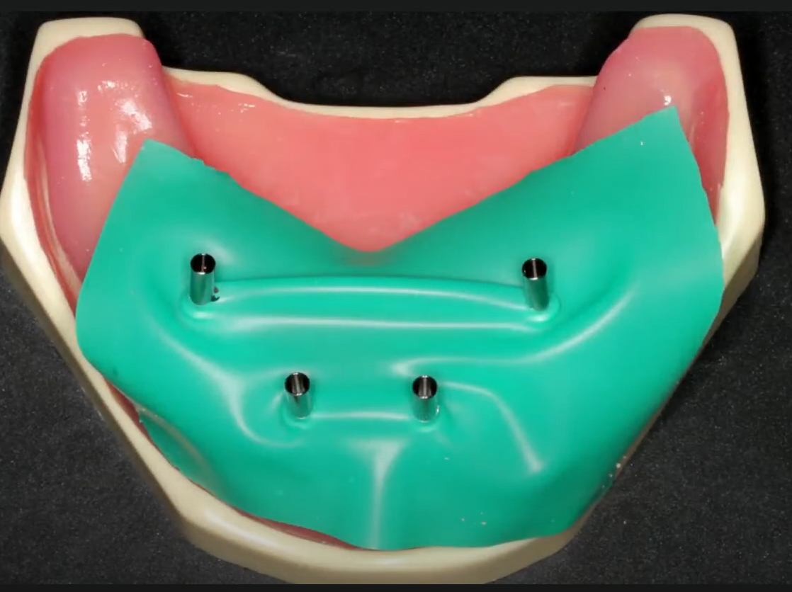 Placing a rubber dam before relining a prosthesis