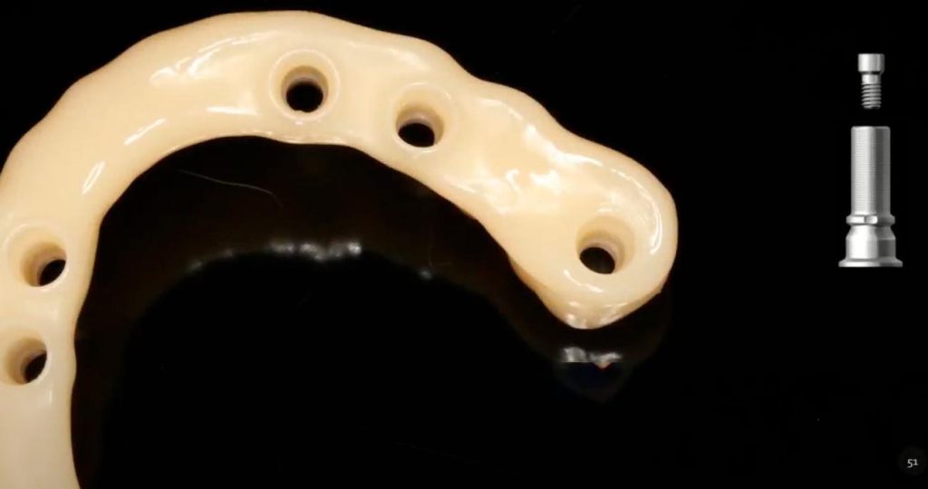 The highly polished intaglio surface of a PMMA temporary denture, designed to prevent food impaction and inflammation.