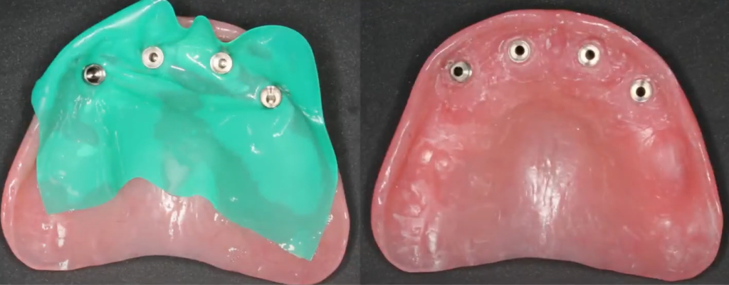 The temporary denture is marked with a pen to indicate areas needing trimming and finishing for a precise fit.