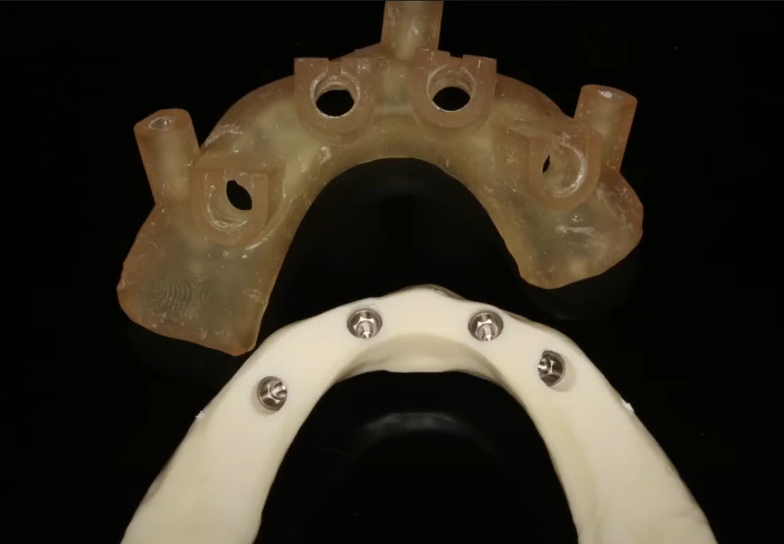 Study model of a jaw with placed implants and an R2Gate surgical template