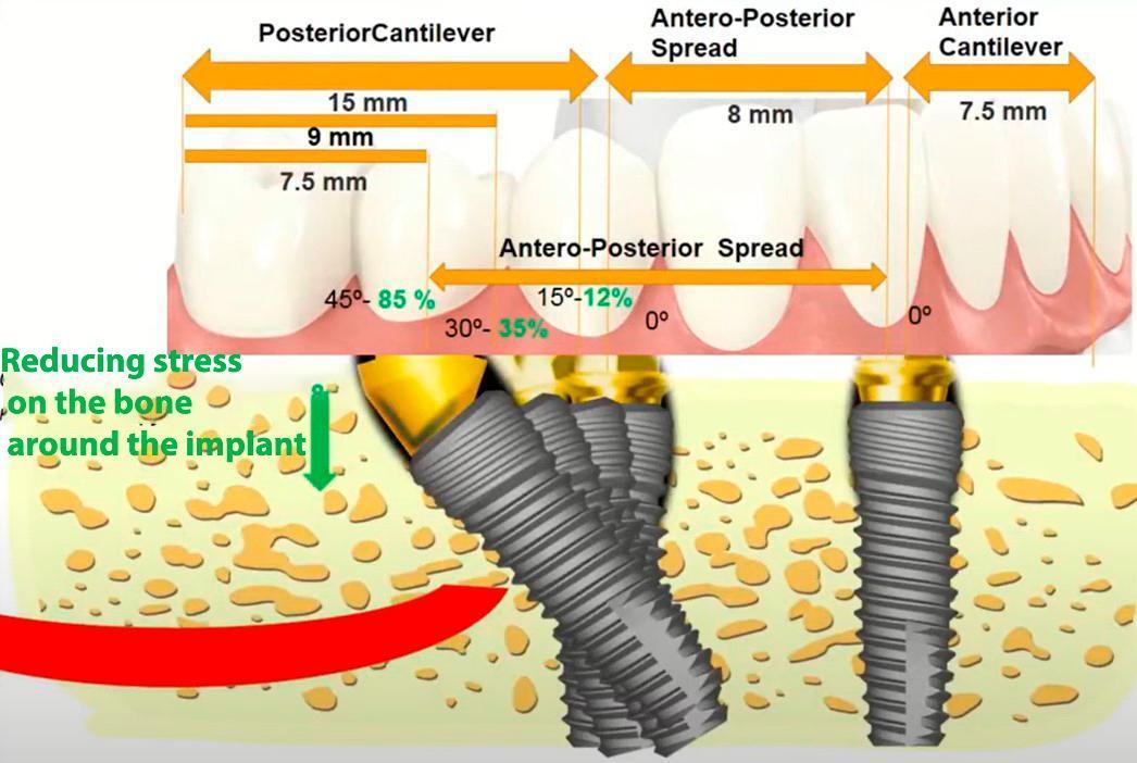Reducing the cantilever length of the prosthesis by increasing the implant's angle of inclination (mandible)