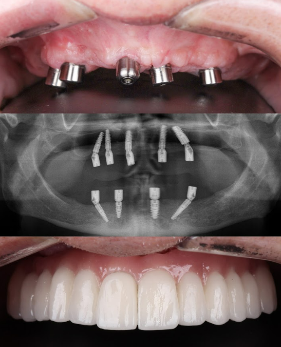 Restoring a dental arch with angled abutments and tilted implants from Shutterstock Restoring a dental arch with angled abutments and tilted implants from Shutterstock
