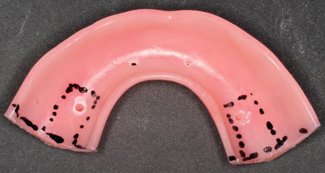 Marking the contact area of the temporary prosthesis with the mucosa