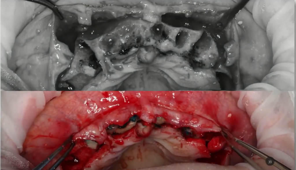 Surgical site in the upper jaw with the gum flap raised in preparation for dental implant placement.