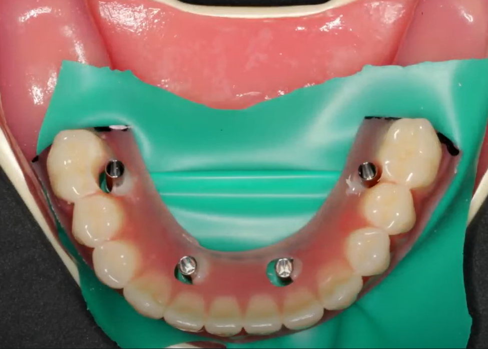 Stabilizing the prosthesis