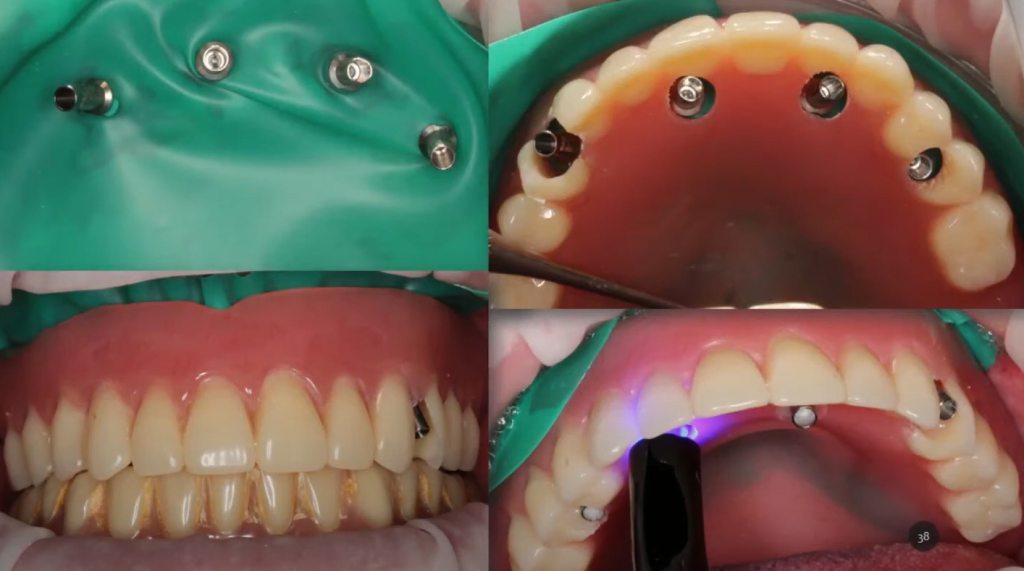 The process of fitting a temporary denture by luting temporary cylinders into the prosthesis body inside the patient's mouth.
