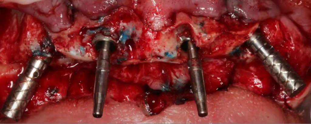 Four dental implants shown after placement in the upper jawbone, with distal implants tilted to avoid anatomical limitations.