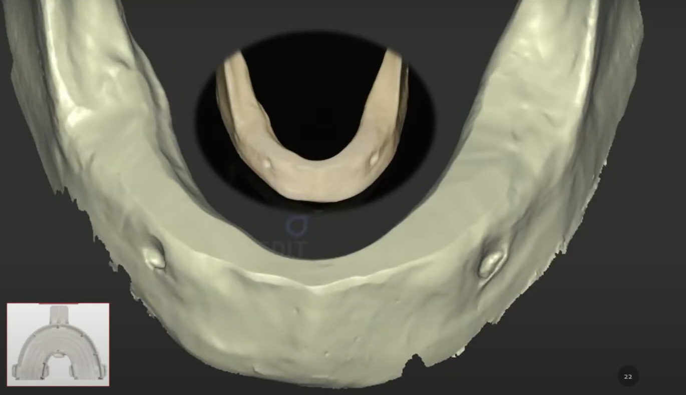 Virtual model of the patient's lower jaw