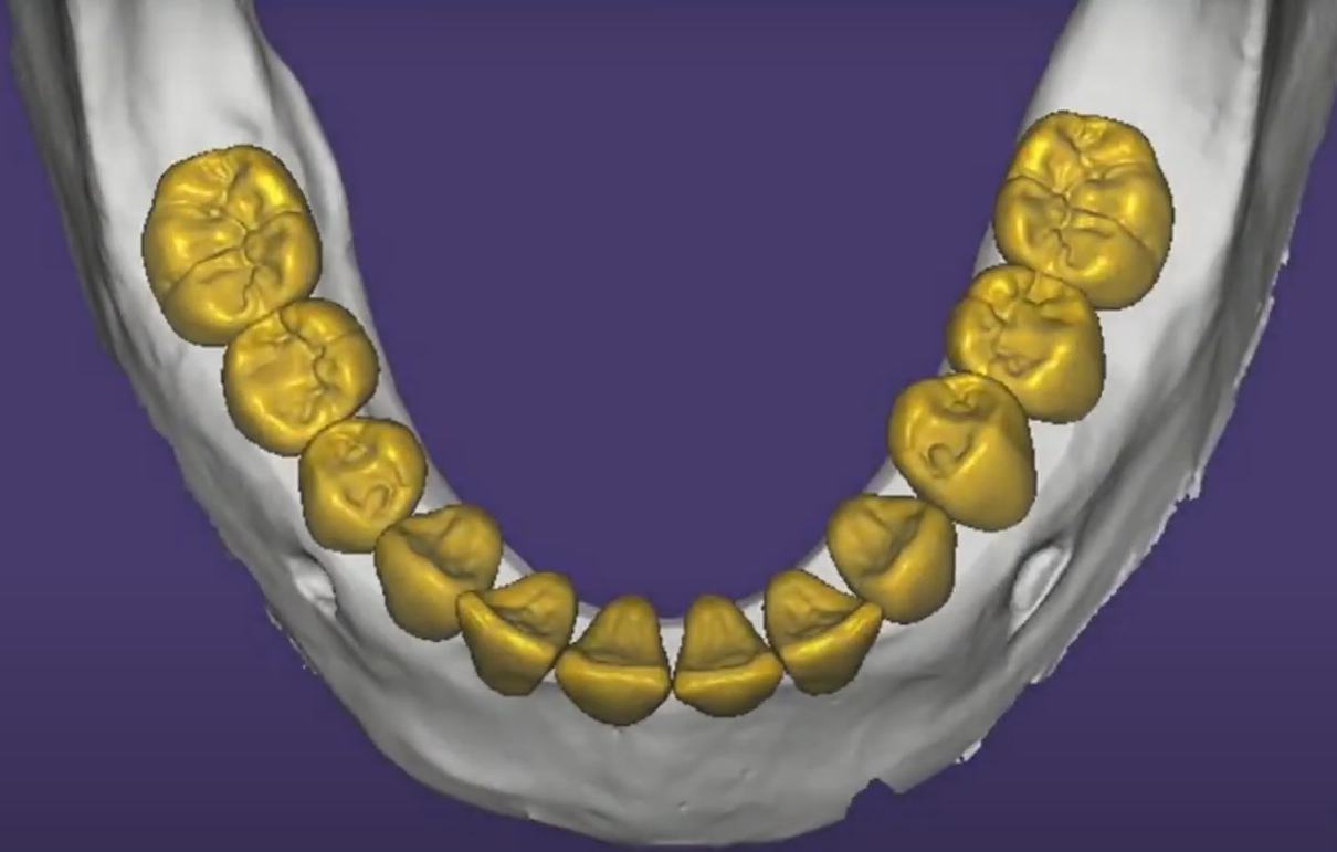 Virtual model of the future dentition