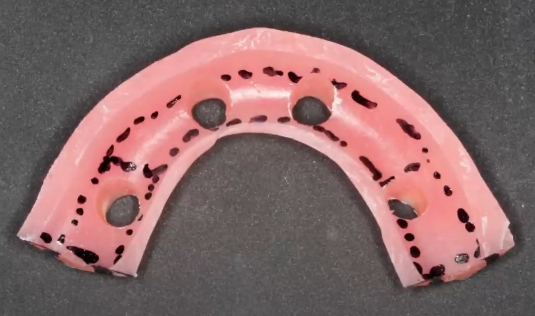 Holes widened for fitting the prosthesis onto temporary cylinders