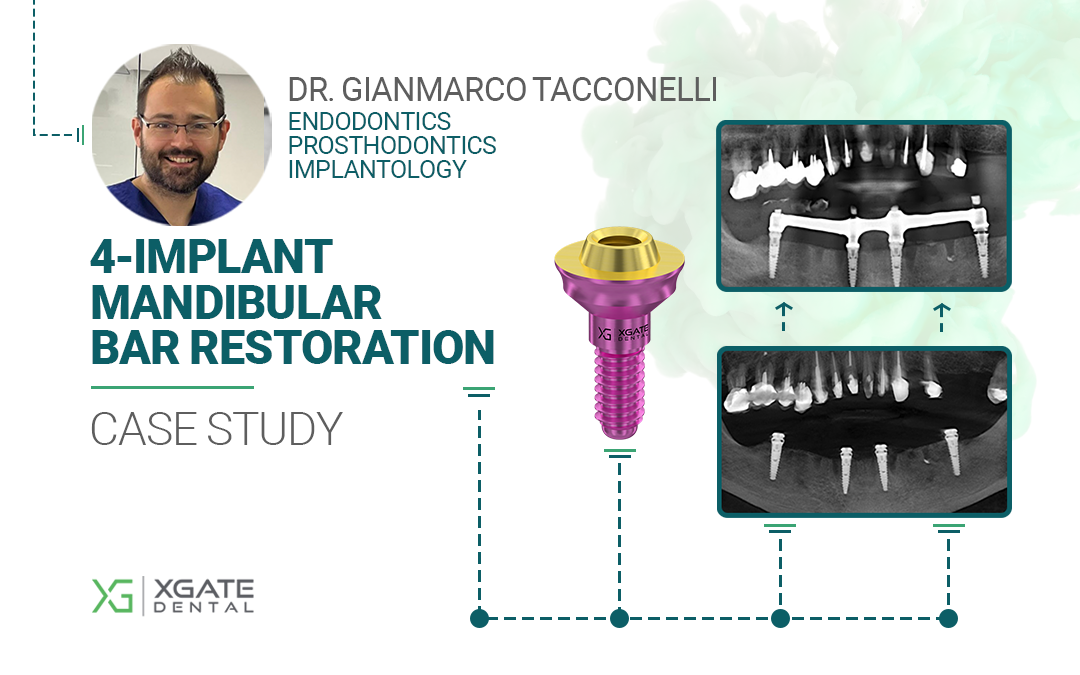 Dr. Goykhman restored both dental arches using 6 maxillary and 4 mandibular implants with XGate multi-unit abutments. Dr. Goykhman restored both dental arches using 6 maxillary and 4 mandibular implants with XGate multi-unit abutments.