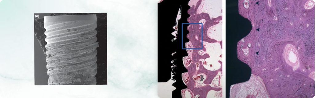 What to Do When an Implant Spins: What We Know About the Potential for Reosseointegration