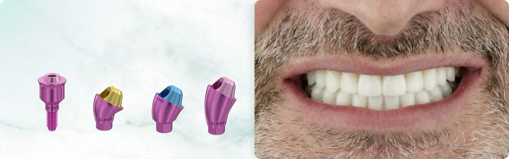 Full-Mouth Rehabilitation. Screw-retained MUA by XGATE