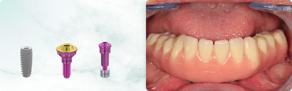 Mandibular Rehabilitation with a Bar-Supported Prosthesis on 4 Implants Using XGATE Products