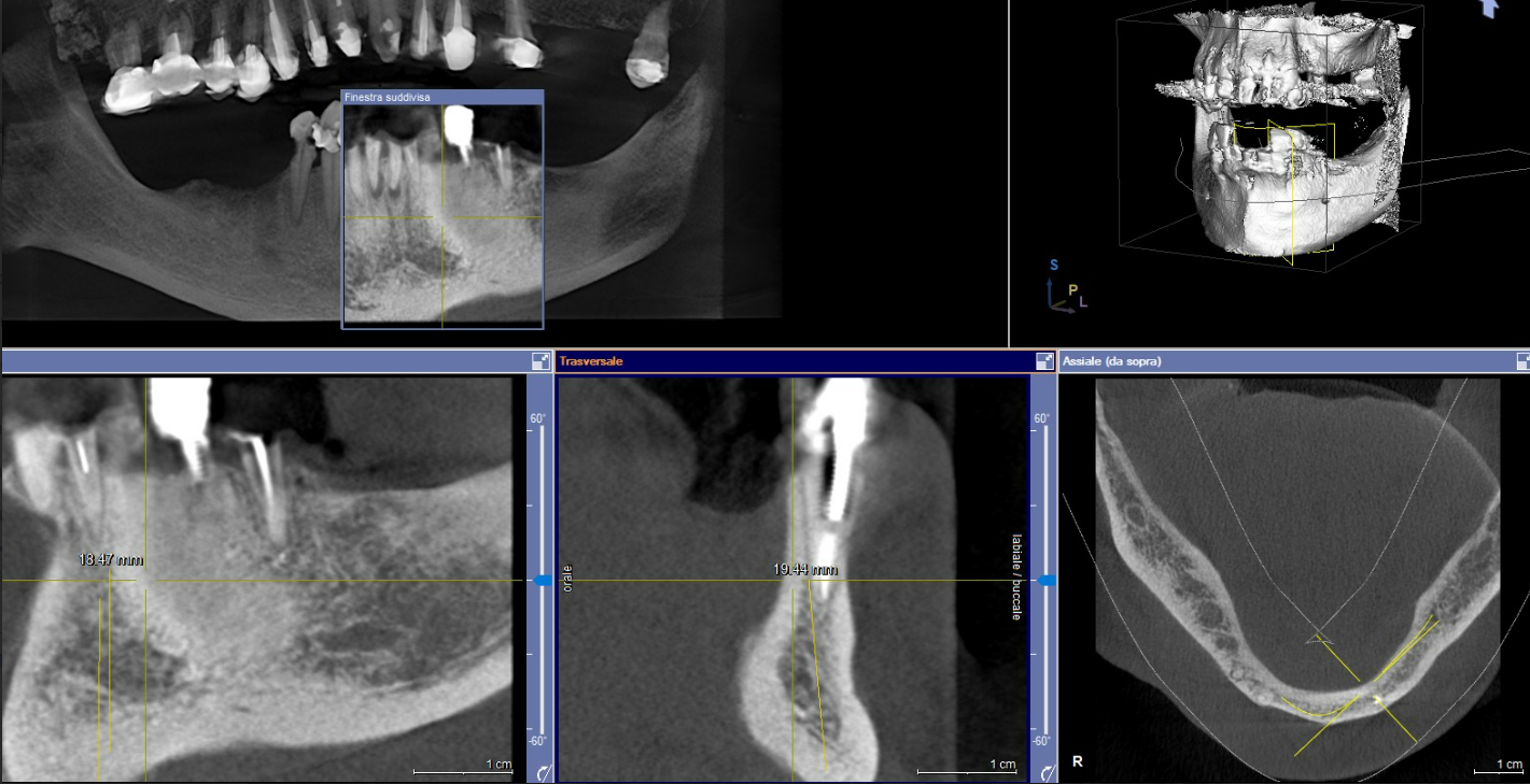 A series of CBCT scan images used for analyzing the residual bone volume in the mandible for implant placement planning.