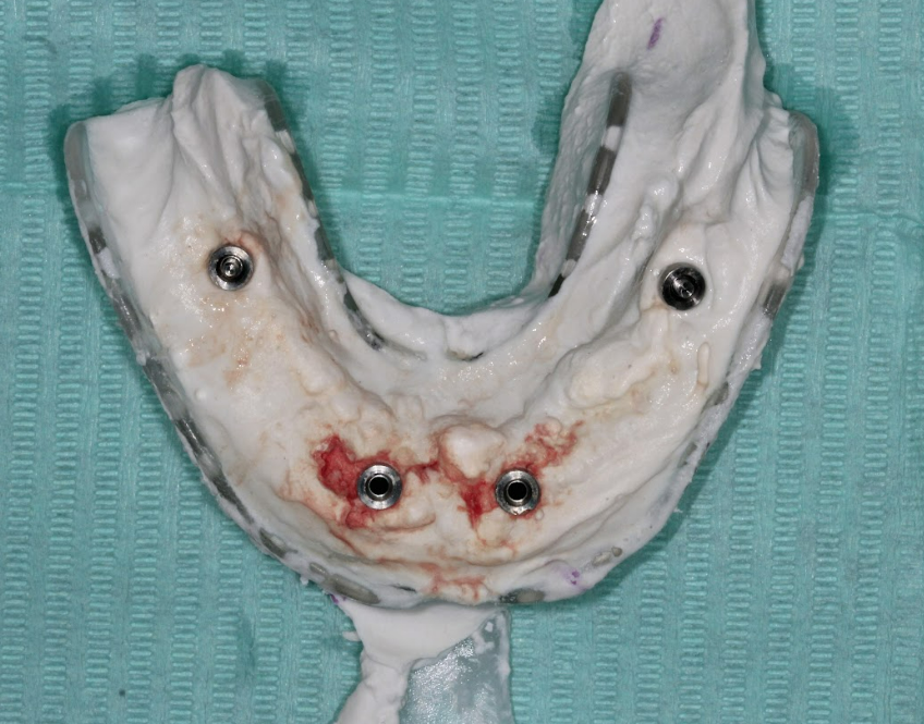 A photo of the new, highly accurate plaster impression taken 48 hours post-operation to correct the fit of the prosthetic bar.