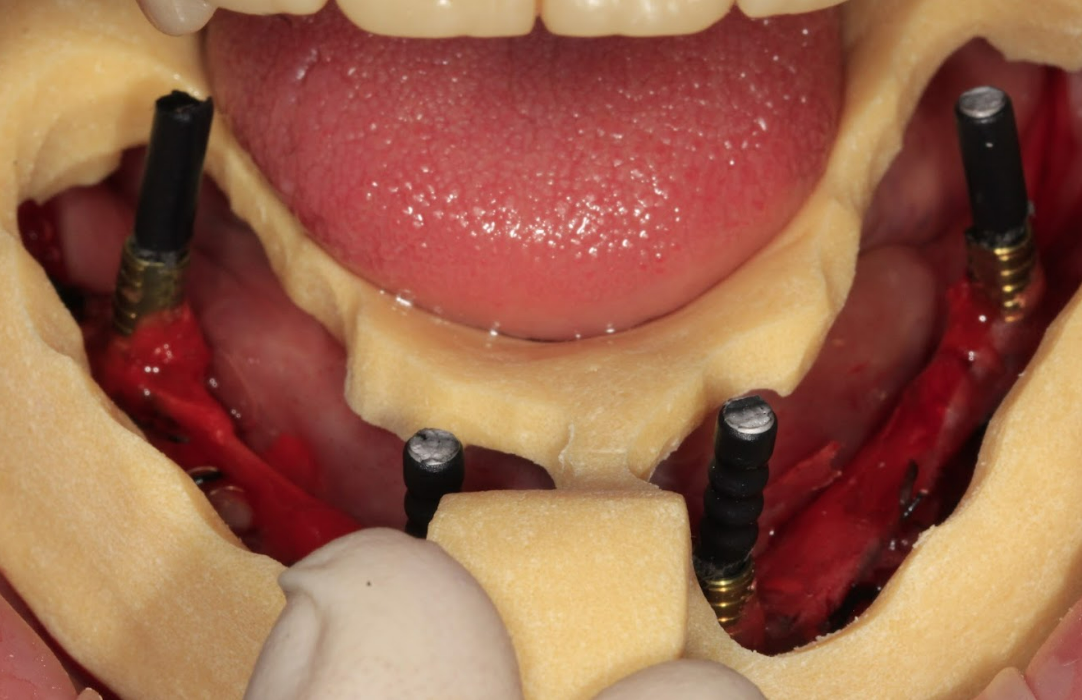 An intraoral photo showing the impression phase with a custom tray and splinted impression copings to ensure an accurate model.